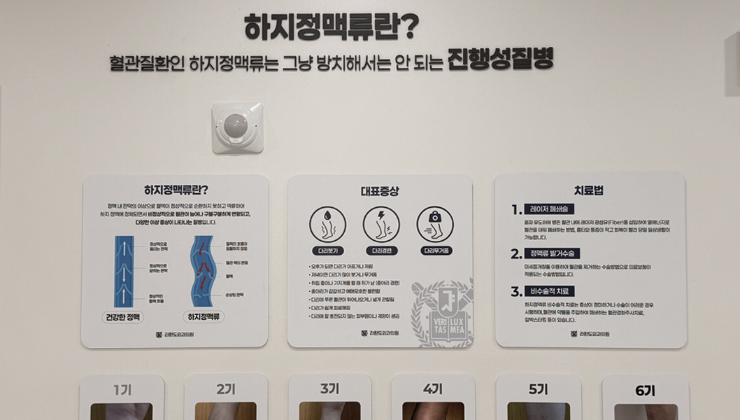 하지정맥류란